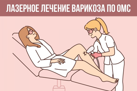 Лазерное лечение варикоза по ОМС